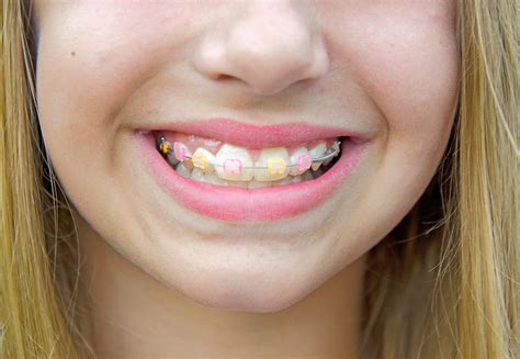 best color for clear braces.